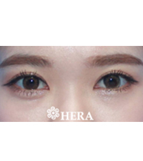 韩国赫拉（HERA）整形医院双眼皮案例对比图