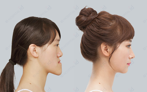 韩国下颌角整形对比