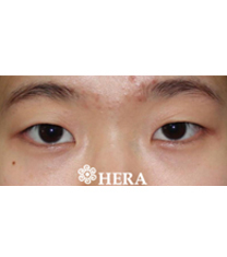 韩国赫拉HERA整形医院-韩国赫拉（HERA）整形医院双眼皮案例对比图