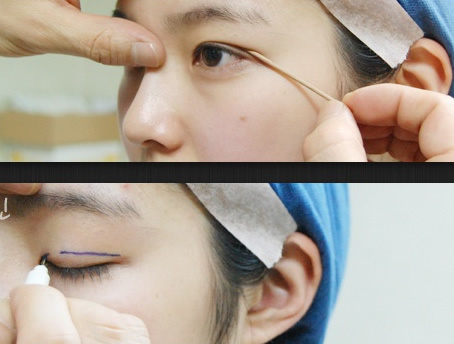 哪种割双眼皮方法好，手术时间要多久？