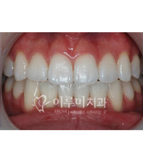 韩国erumi牙科医院牙齿美白案例对比图