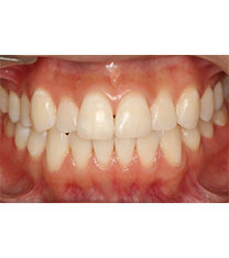 韩国CALIFORNIA牙科-韩国CALIFORNIA牙科牙齿美白案例对比图