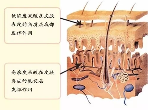 果酸換膚對(duì)皮膚作用卡通示意圖