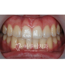 韩国erumi牙科医院牙齿美白日记对比图