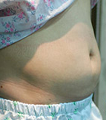 韩国德克莱斯（classic）整形医院腰腹吸脂案例对比图_术前