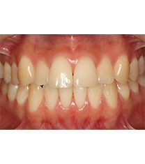 韩国CALIFORNIA牙科牙齿美白案例对比图