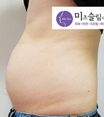 韩国美姿mizslim医院-韩国美姿（mizslim）吸脂医院腹部吸脂案例对比图
