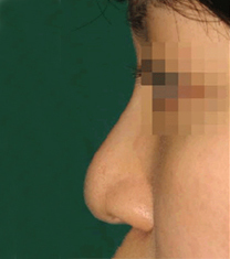 韩国CNM（COANMI）整形外科医院隆鼻案例对比图_术前