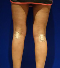 韩国HAFIS整形外科-韩国HAFIS整形医院腿部吸脂日记对比图