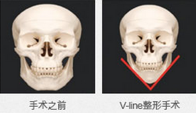 V脸手术骨骼示意图
