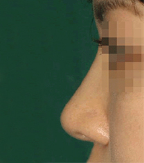 韩国CNM（COANMI）整形外科医院隆鼻案例对比图_术后