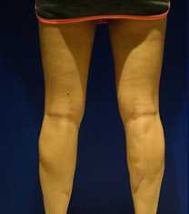 韩国HAFIS整形医院腿部吸脂案例对比图