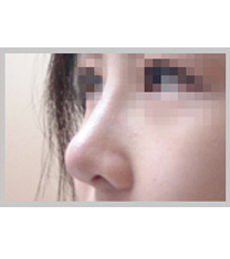 韩国美人制造整形外科隆鼻整形案例对比图