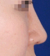 韩国A-one整形外科医院驼峰鼻矫正案例对比图