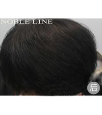韩国Noble Line医院植发案例对比图