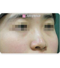 韩国时雨整形外科隆鼻手术日记对比图