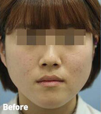 韩国Toxnfill整形外科瘦脸瘦脸日记对比图_术前