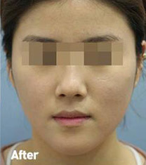 韩国Toxnfill整形外科瘦脸瘦脸日记对比图_术后