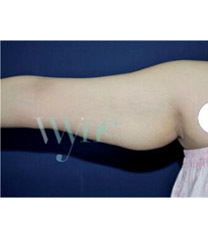 韩国维茵整形外科&皮肤科手臂吸脂+埋线提升术日记对比图