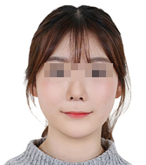 韩国诺宝丝整形外科医院颧骨缩小案例对比图