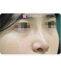 韩国时雨整形外科隆鼻手术案例对比图_术后