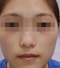 韩国Clean N 皮肤科医院祛斑日记对比图