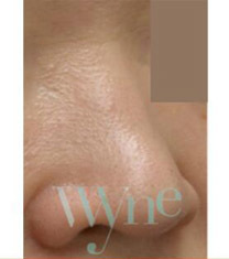 韩国维茵整形外科-韩国维茵整形外科&皮肤科玻尿酸隆鼻案例对比图