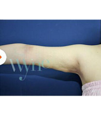 韩国维茵整形外科&皮肤科手臂吸脂+埋线提升术日记对比图