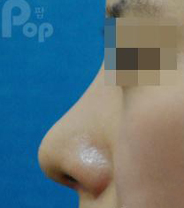 韩国POP整形外科-韩国POP整形外科驼峰鼻矫正日记对比图