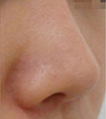 造颜整形外科鼻尖延长案例对比图