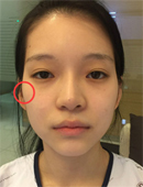 韩国推出“处女脸”整形案例，风格完爆网红风！