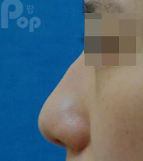 韩国POP整形外科-韩国POP整形外科驼峰鼻矫正日记对比图