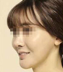 韩国Minerva整形外科面部重塑提升案例对比图