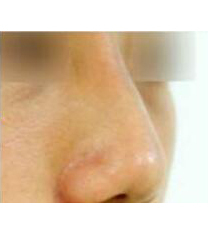 韩国LaPrin(来菲琳）整形外科驼峰鼻矫正日记对比图