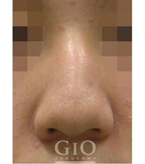 韩国GIO整形外科-韩国GIO整形外科歪鼻矫正手术案例对比图