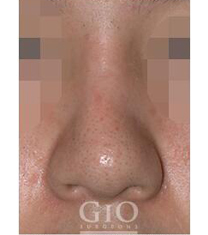 韩国GIO整形外科-韩国GIO整形外科歪鼻矫正手术案例对比图