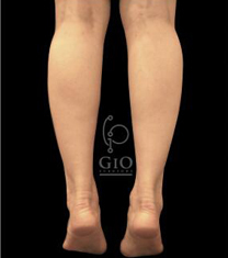 韩国GIO整形外科-韩国GIO整形外科小腿整形案例对比图