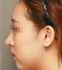韩国D&A整形外科医院隆鼻案例对比图_术后