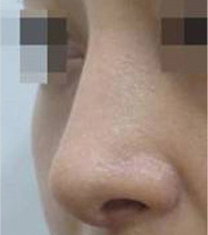 韩国SamSkin整形外科-​韩国SamSkin整形外科鹰钩鼻矫正手术日记对比图