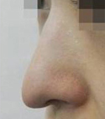 ​韩国SamSkin整形外科鹰钩鼻矫正手术日记对比图