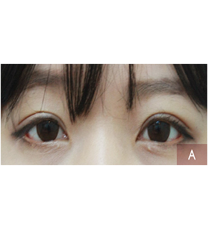 Arumlines整形医院-韩国美line整形医院双眼皮对比案例