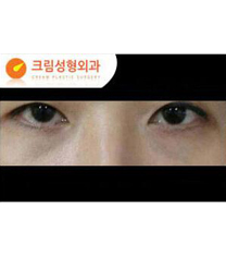 韩国Cream整形外科去眼袋案例对比图