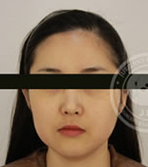 姿飞抗老化医学中心-韩国姿飞抗老化医学美容中心面部轮廓日记对比图