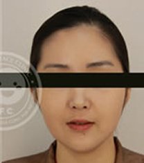韩国姿飞抗老化医学美容中心面部轮廓日记对比图