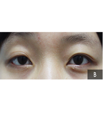 Arumlines整形医院-韩国美line整形医院双眼皮对比案例