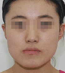 韩国Zeah牙科医院地包天矫正案例对比图