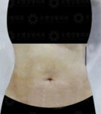 韩国Oell（原Aqua）整形外科腰腹吸脂案例对比图