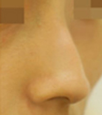 韩国Armline整形外科鹰钩鼻矫正案例对比图