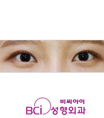 韩国BCI整形外科双眼皮手术日记对比图