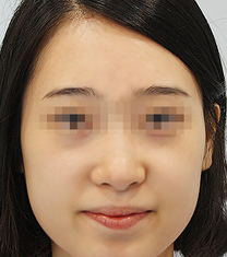 韩国Bustium整形外科面部轮廓整形日记对比图